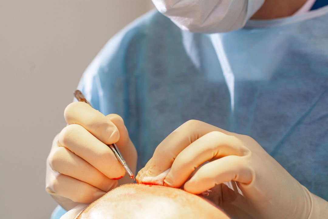 Curso Superior Universitario de Técnicas Avanzadas en Implantes Capilares para Técnico Auxiliar Online
